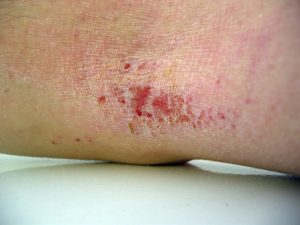 TSB Eczema Image 1