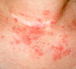 TSB Eczema Image 2